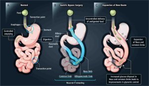 Best ADHD Medication After Gastric Bypass